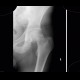 Hip fracture, femoral neck, subcapital fracture, Pauwels A: X-ray - Plain radiograph